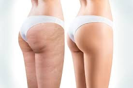 5 sesiones Celulitis off + 2 Envolturas Detox